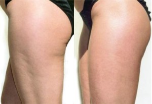 revitol before and after 2