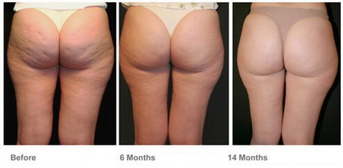 revitol before and after 3