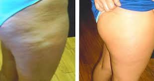 revitol before and after